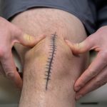 Mobilizacija pogačice po operaciji kolena za izboljšanje gibljivosti, zmanjšanje bolečine in preprečevanje brazgotinjenja.