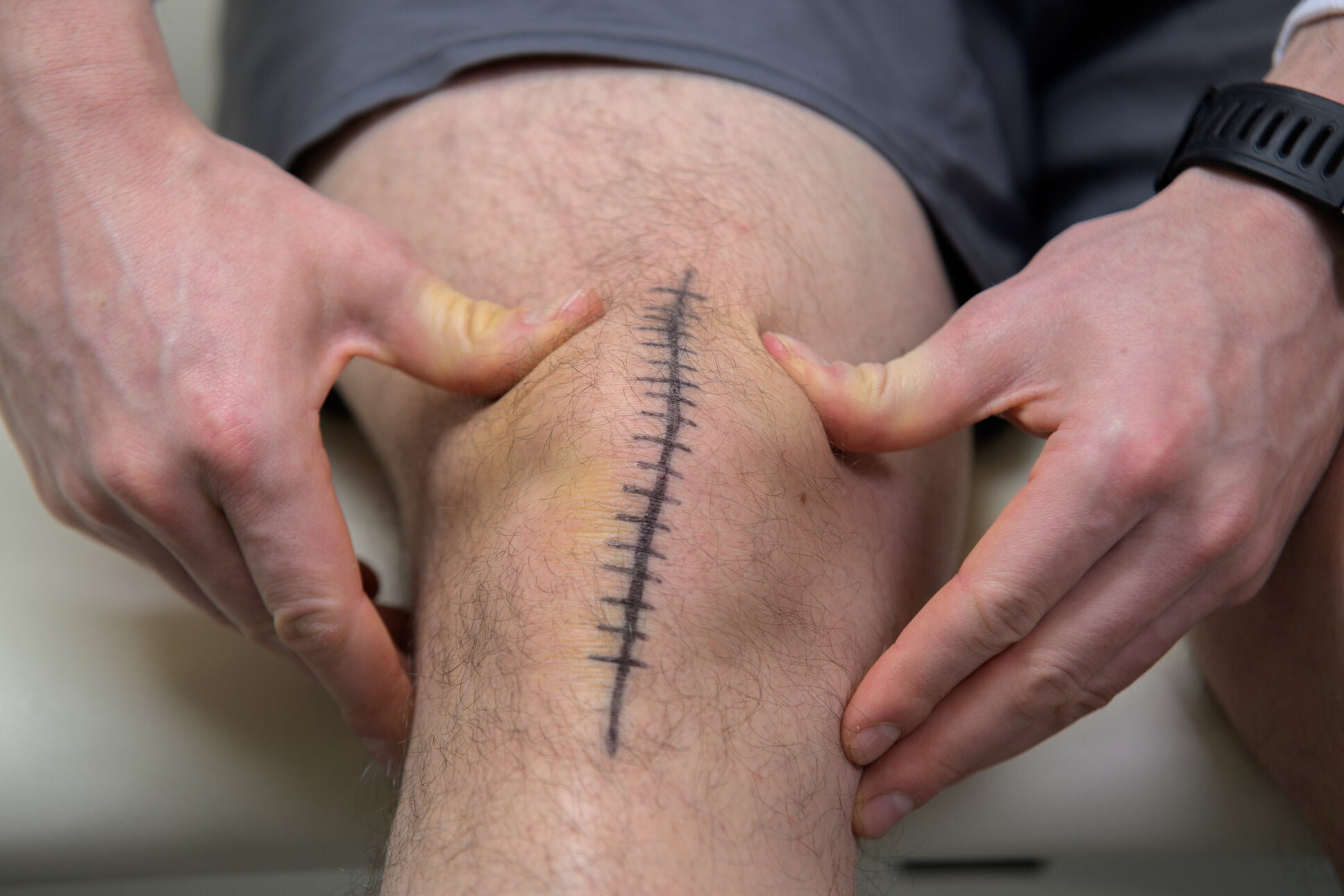 Mobilizacija pogačice po operaciji kolena za izboljšanje gibljivosti, zmanjšanje bolečine in preprečevanje brazgotinjenja.