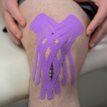 Kineziološki trakovi na kolenu po operaciji za zmanjšanje otekline in podporo pri rehabilitaciji.
