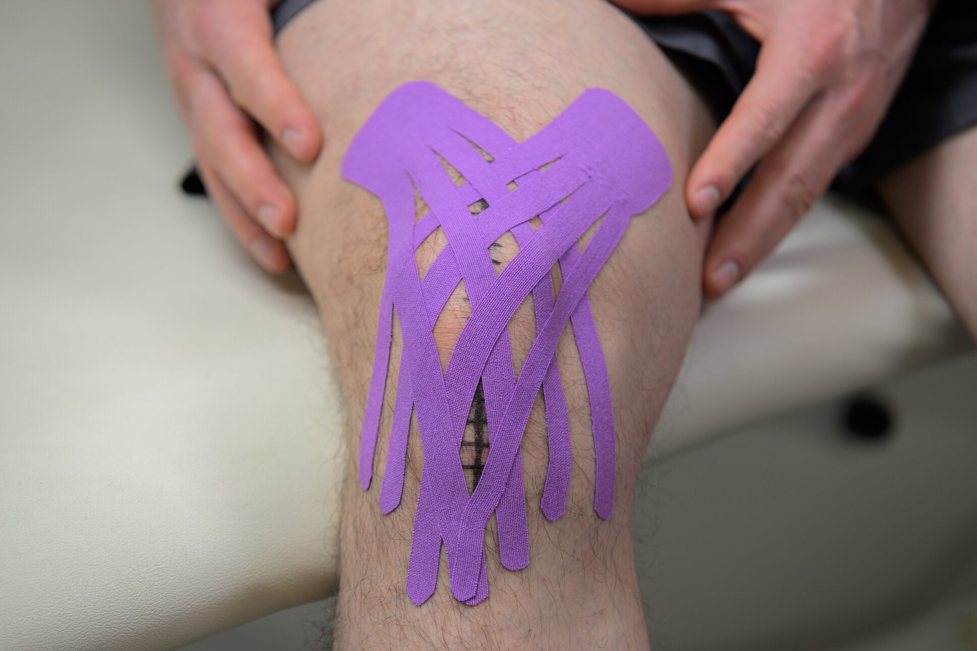 Kineziološki trakovi na kolenu po operaciji za zmanjšanje otekline in podporo pri rehabilitaciji.